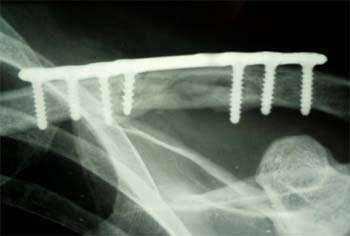 Chirurgie d'une fracture de la clavicule avec pose d'une plaque anatomique