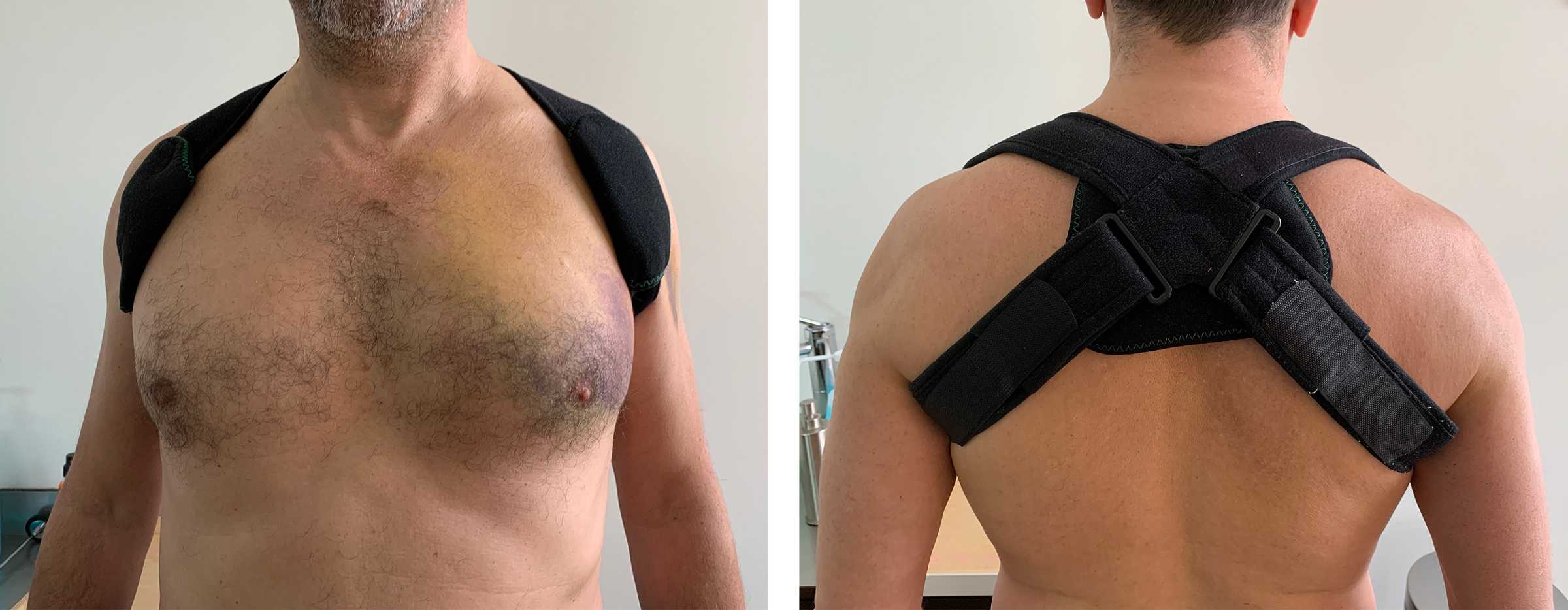 Fracture de la clavicule diagnostic et traitement chirurgical