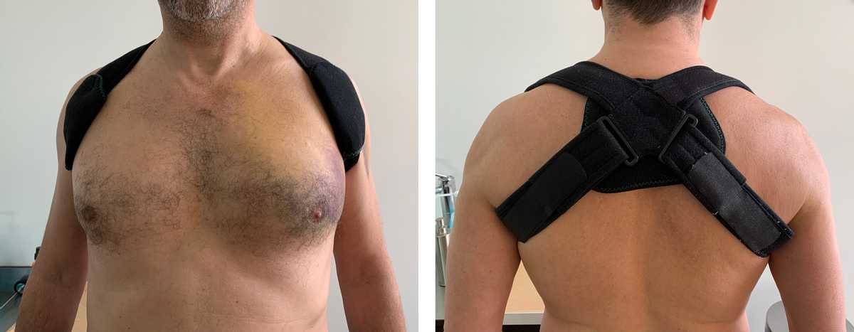 Port d'anneaux claviculaires pour soigner une fracture de la clavicule