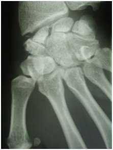 Examen d'une pseudarthrose du scaphoïde