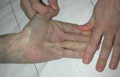 Diagnostic de la maladie de Dupuytren