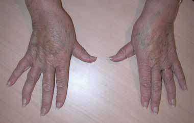 Diagnostic de la rhizarthrose lors d'un examen par un médecin ou un chirurgien à Paris