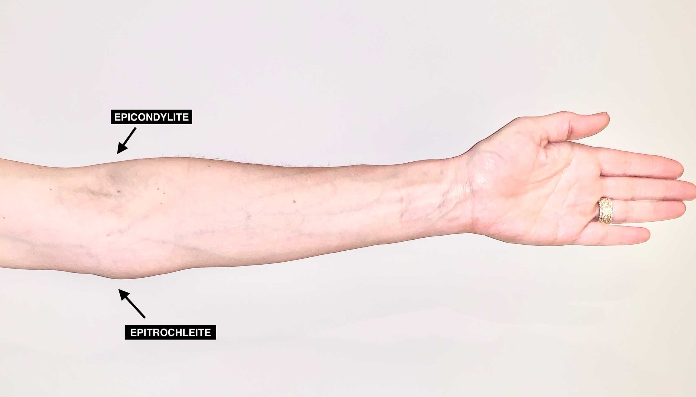 Épicondylite Tendinite du coude Diagnostic et chirurgie