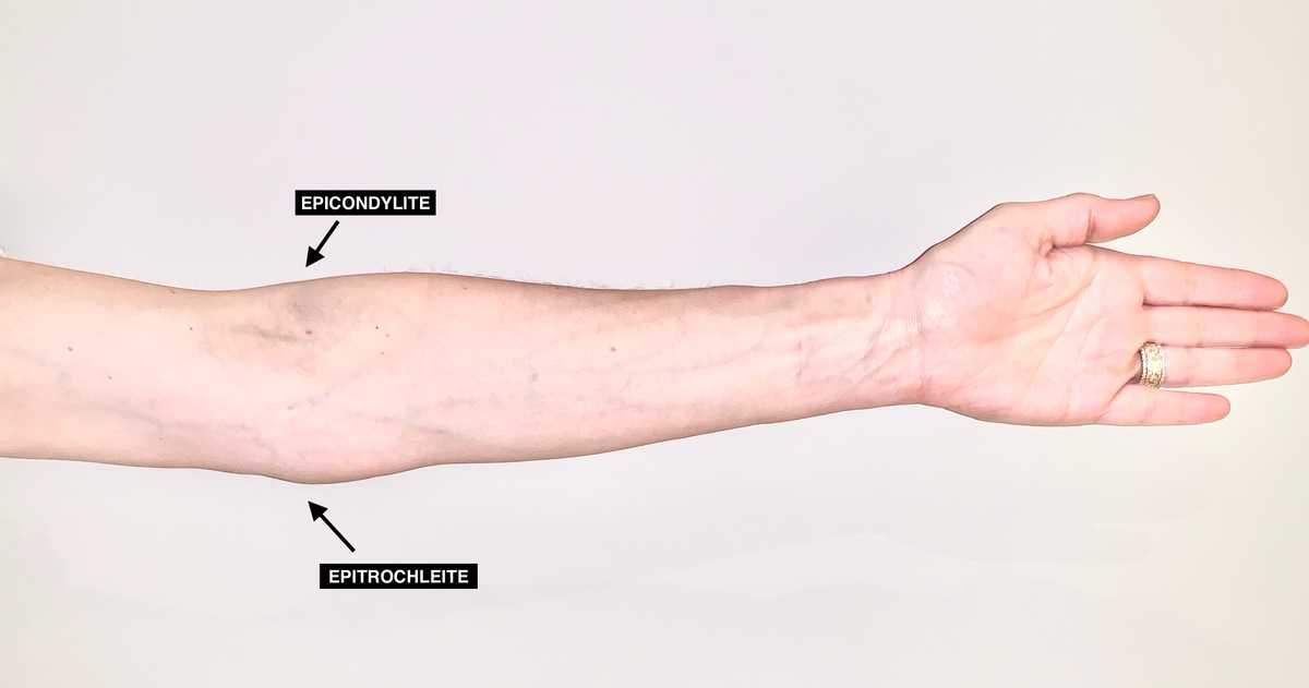 Schéma d'une épitrochléite, la tendinite médiale du coude