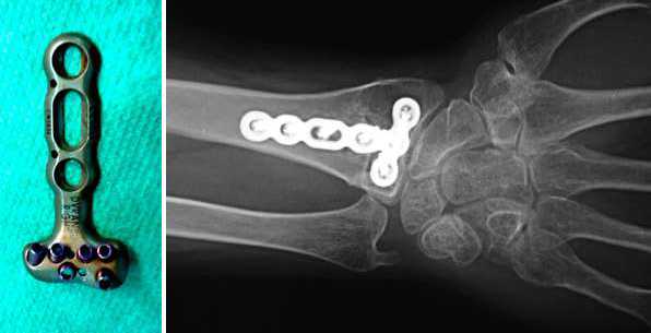Plaque anatomique posée suite à une fracture du poignet