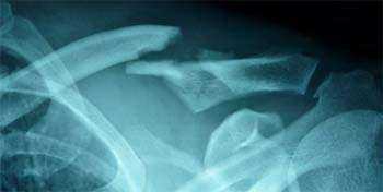 Examen par scanner d'une fracture de la clavicule