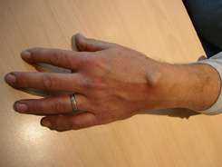 Diagnostic du kyste synovial