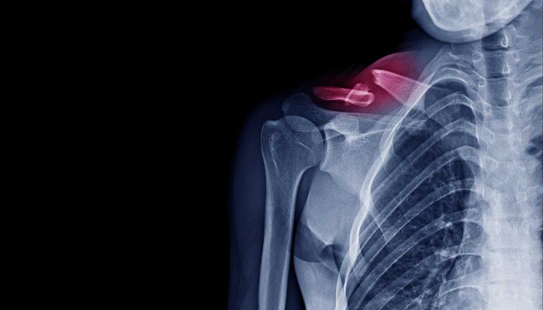 Fracture de la clavicule diagnostic et traitement chirurgical
