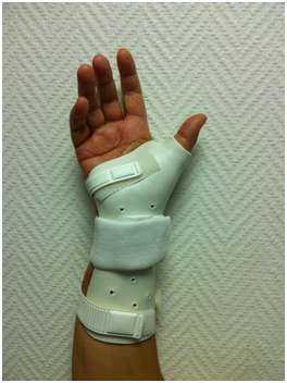 Attelle thermoformable utilisée dans le cadre d'un traitement d'une rupture du scaphoïde par immobilisation