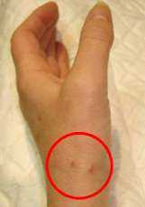 Incisions réalisés dans le cadre d'une chirurgie de la rhizarthrose par arthroscopie