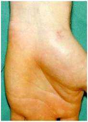 Réalignement des fragments osseux