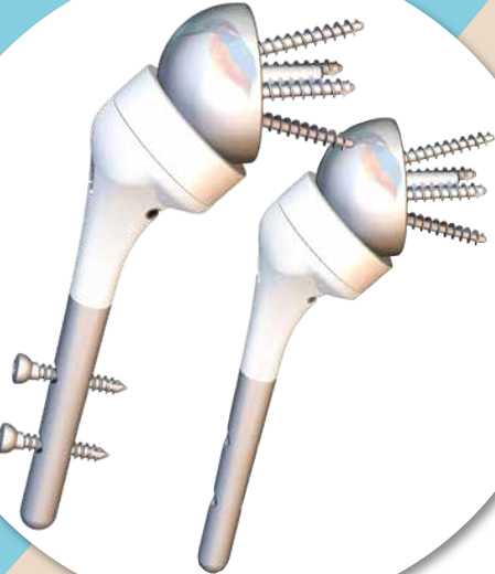 Prothèse totale d’épaule inversée