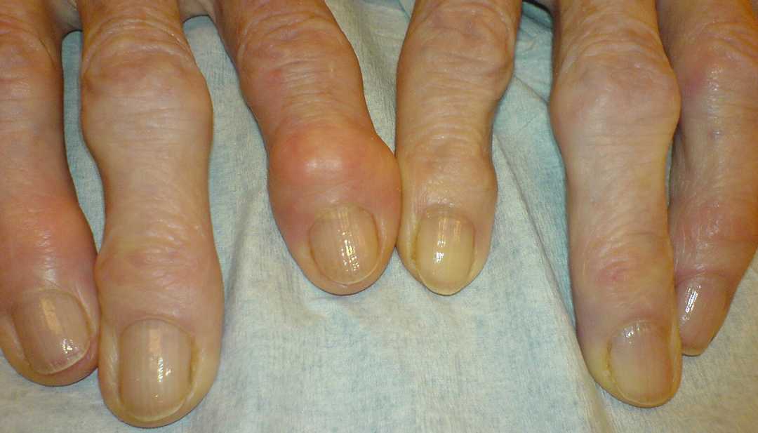 Arthrose des doigts Diagnostic et traitements Dr Roure — free download