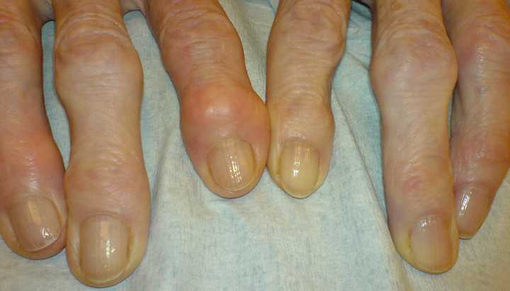  Arthrose des doigts : Diagnostic et chirurgie à Paris