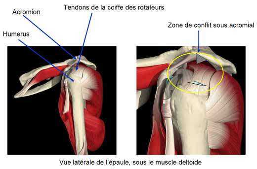 Sub-acromial conflict
