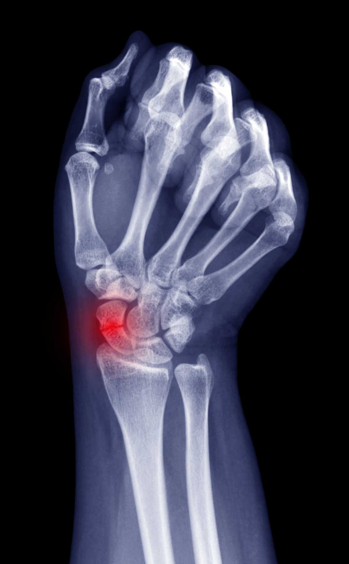 Radiographie d'une pseudarthrose du scaphoïde