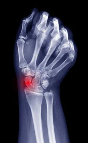 Pseudarthrose du scaphoïde : diagnostic et chirurgie