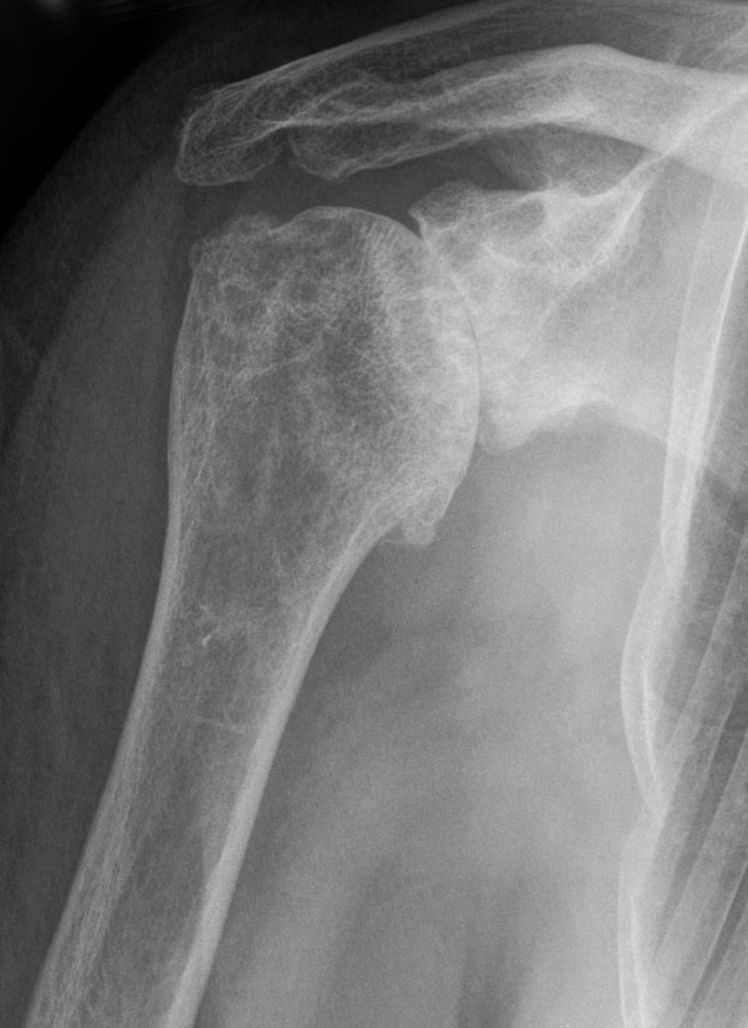 Radio d'arthrose de l'épaule