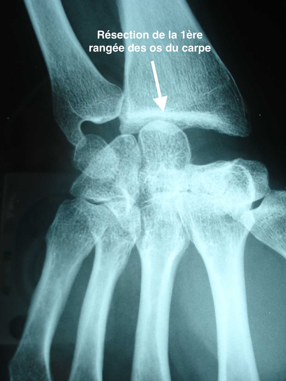 Résection de la 1ère rangée des os du carpe